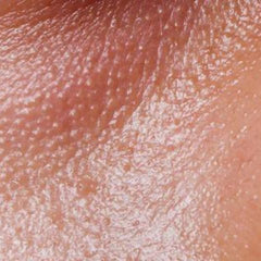 nærbillede af tør hud